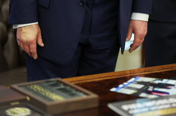 Donald Trump volta a ser visto com maquiagem na mão após diagnóstico de insuficiência venosa crônica. Casa Branca afirma que manchas são causadas por aspirina e apertos de mão.